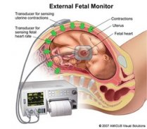 Usefulness of Continuous Fetal Monitoring During Labour