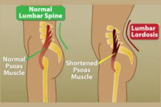 Psoas